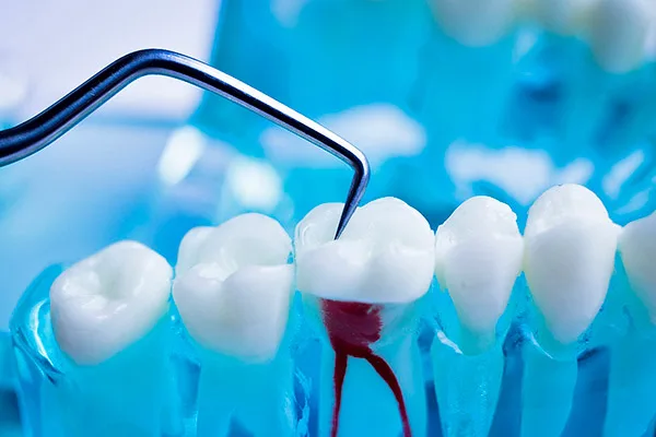 endodoncia